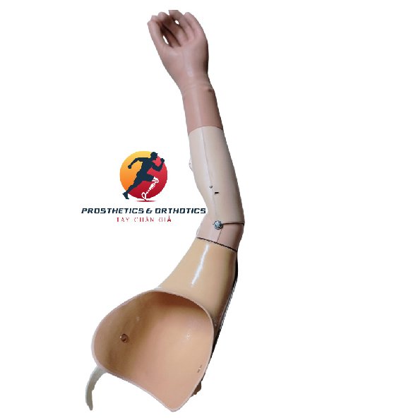 Tay giả cơ học trên khuỷu